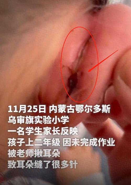 一年級女生課堂上“走神”被老師揪傷耳朵縫5針；教育局：涉事者已被停課